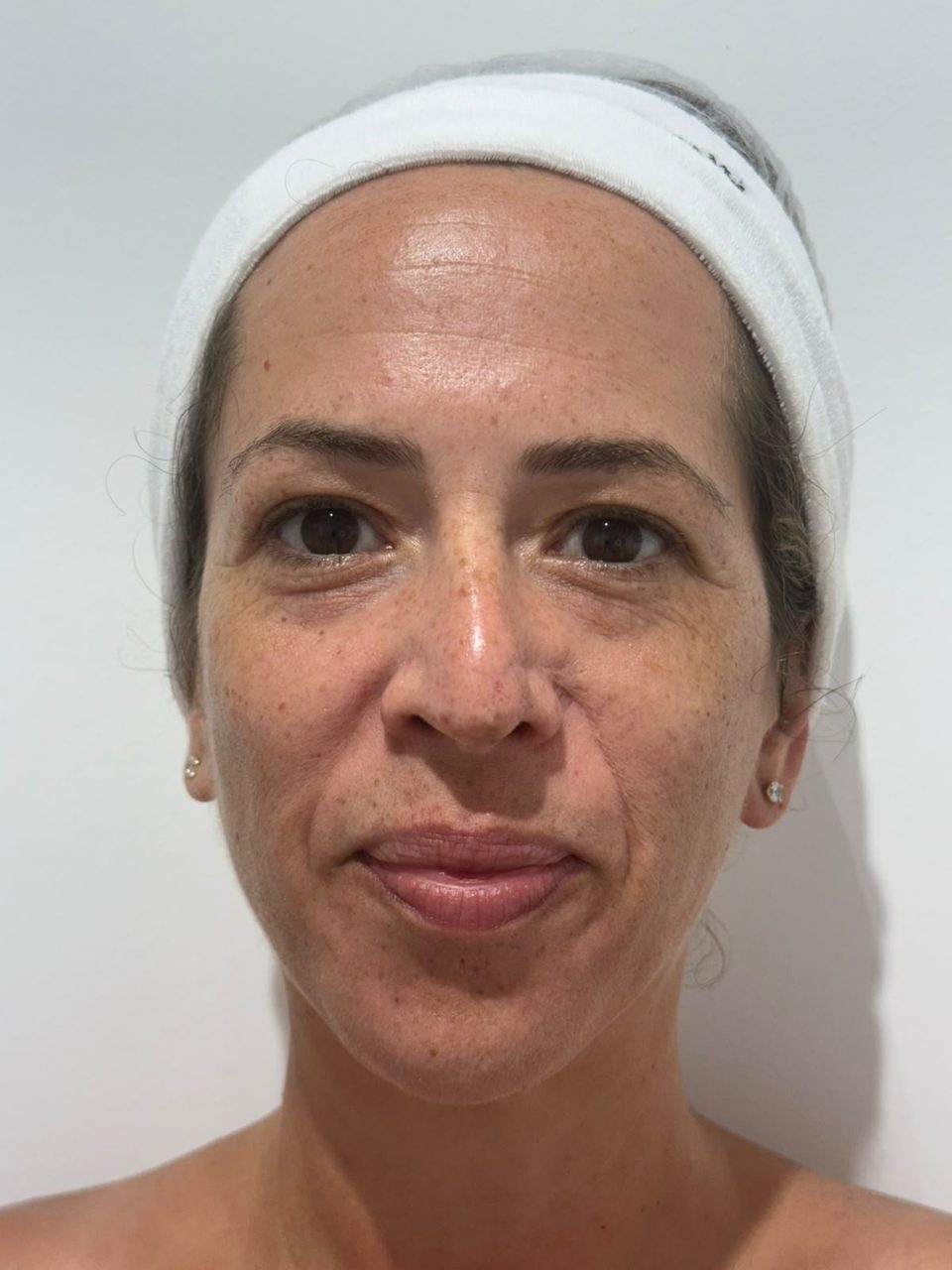 איכות העור ומיצוק