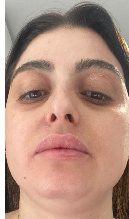 תוצאת טיפול אמיתית של מטופלת 5, אחרי
