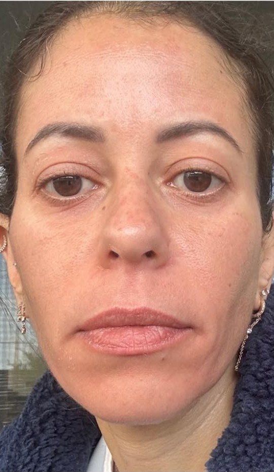 תוצאת טיפול אמיתית של מטופלת 2, אחרי