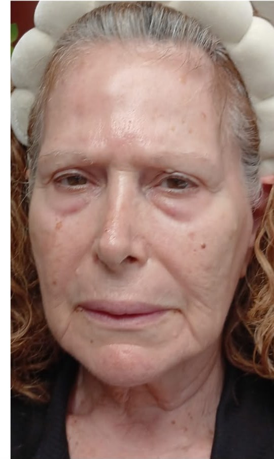 תוצאת טיפול אמיתית של מטופלת 1, אחרי