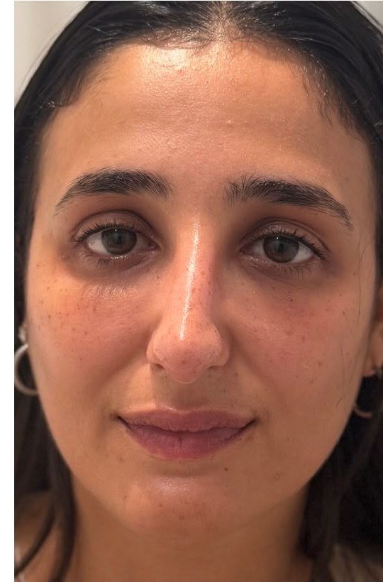 תוצאת טיפול אמיתית של מטופלת 3, אחרי